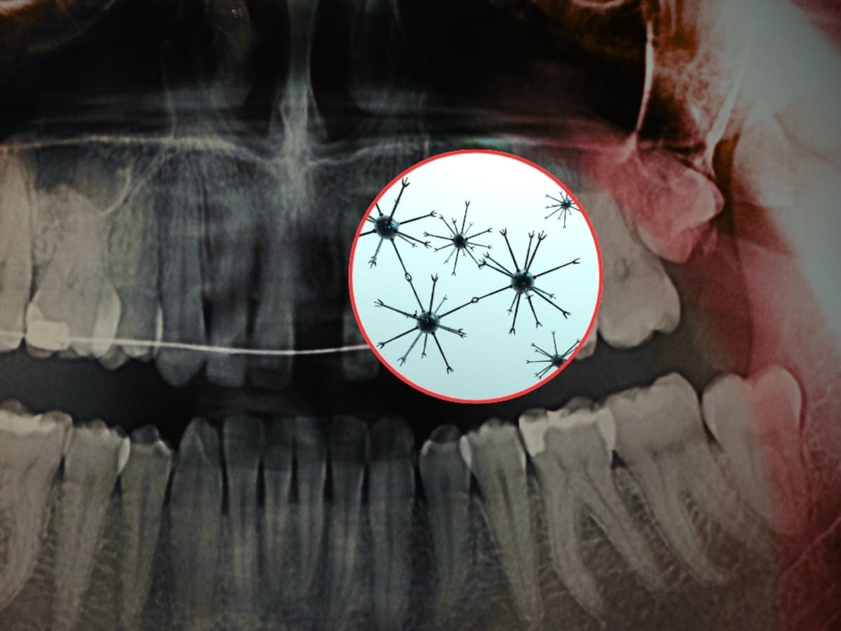 Científicos crearon nanorobots magnéticos para eliminar la sensibilidad dental en solo 20 minutos, penetrando hasta 500 micrómetros dentro del diente para sellar la dentina desde el interior, lo que daría alivio duradero sin necesidad de usar pastas especiales o ir al dentista