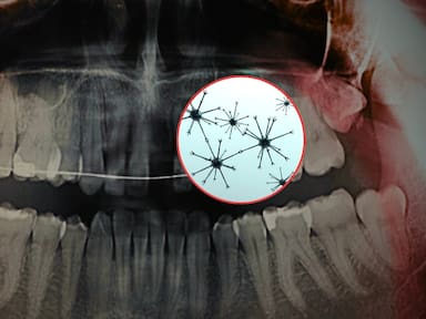 Científicos crearon nanorobots magnéticos para eliminar la sensibilidad dental en solo 20 minutos, penetrando hasta 500 micrómetros dentro del diente para sellar la dentina desde el interior, lo que daría alivio duradero sin necesidad de usar pastas especiales o ir al dentista